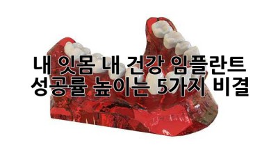 내 잇몸, 내 건강! 임플란트 성공률 높이는 5가지 비결